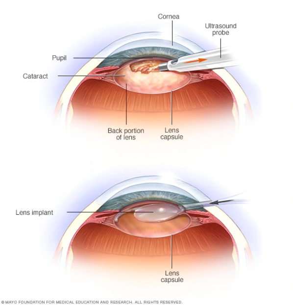 Cateract, cataract cataract surgery cataract recovery cataract surgery recovery eye surgery laser cataract laser cataract surgery 
