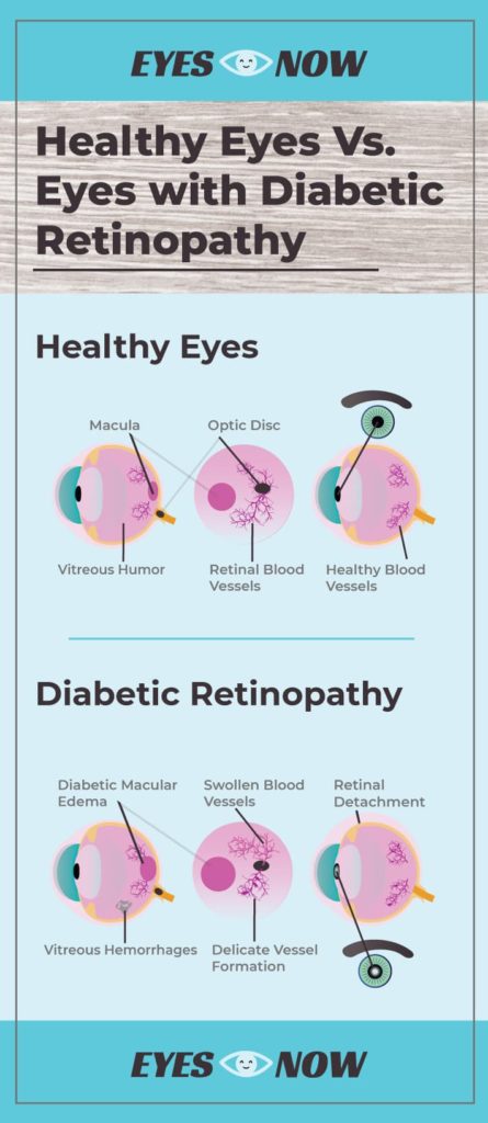 Diagram showing the difference between healthy eyes and eyes with diabetic retinopathy