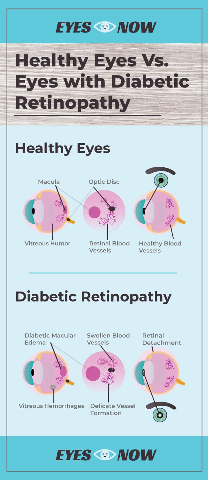 How Diabetes Affects Your Eyes   Eyes Now