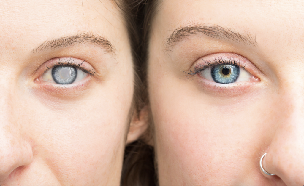 Comparison of lady before her cataract surgery on the left hand side and after cataract surgery on the right hand side.